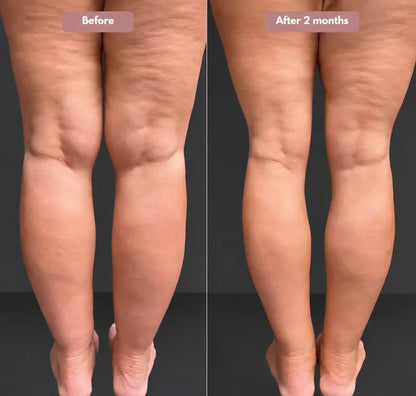 3D™ Lipedema Compression Leggings – Support & Comfort